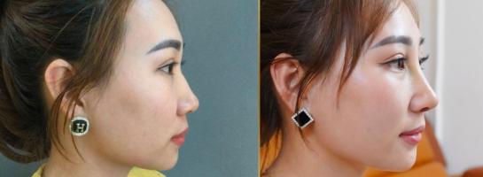 Địa chỉ nâng mũi Hàn Quốc đẹp và uy tín nhất TP. HCM