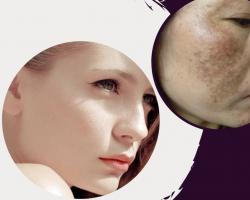 Spa trị nám tốt nhất Cần Thơ