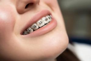 Địa chỉ niềng răng uy tín nhất quận Thanh Xuân, Hà Nội