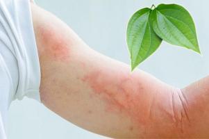Cách trị bệnh mề đay hiệu quả nhất tại nhà