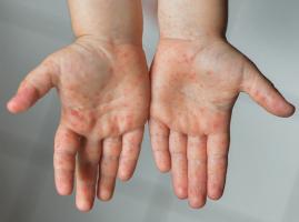 Địa chỉ khám và điều trị bệnh tay chân miệng ở trẻ em tốt nhất tại Hà Nội