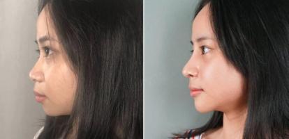 Địa chỉ nâng mũi bọc sụn đẹp và uy tín nhất TP. HCM