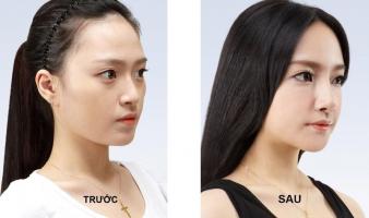 Địa chỉ nâng mũi đẹp và an toàn nhất tỉnh Đắk Lắk
