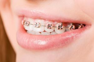 Địa chỉ niềng răng uy tín nhất tỉnh Gia Lai