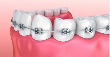 Địa chỉ niềng răng uy tín nhất quận Hai Bà Trưng, Hà Nội