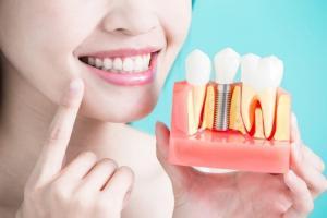 Địa chỉ trồng răng implant tốt nhất tỉnh Quảng Ngãi