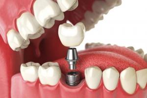 Địa chỉ trồng răng implant uy tín nhất Tây Ninh