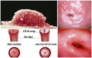 Điều cần biết về ung thư cổ tử cung