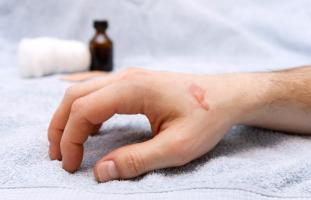 Mẹo chữa bỏng bằng kinh nghiệm dân gian đơn giản nhất