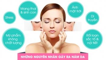 Nguyên nhân gây ra nám da khiến bạn mất tự tin