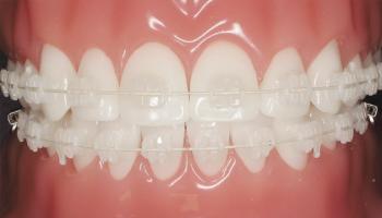 Nha khoa niềng răng mắc cài sứ dây trong uy tín nhất tỉnh Long An