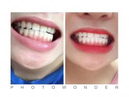 Địa chỉ tẩy trắng răng uy tín nhất tỉnh Thanh Hóa