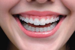 Nha khoa niềng răng mắc cài sứ dây trong uy tín nhất tại Cần Thơ