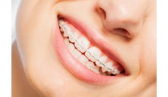 Nha khoa niềng răng mắc cài sứ dây trong uy tín nhất tỉnh Nam Định