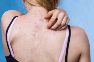 Sản phẩm trị mụn lưng được tin dùng nhất hiện nay