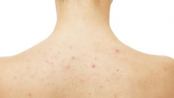 Serum trị viêm nang lông tốt nhất hiện nay