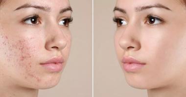 Spa trị mụn hiệu quả nhất Tây Ninh