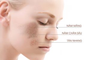 Spa trị nám tốt nhất TP. Vinh, Nghệ An