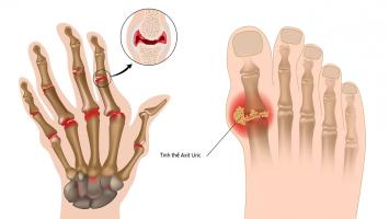 Thói quen giúp phòng ngừa bệnh gout hiệu quả nhất