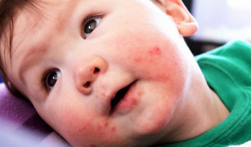 Nốt ban đỏ xuất hiện khi trẻ bị bệnh