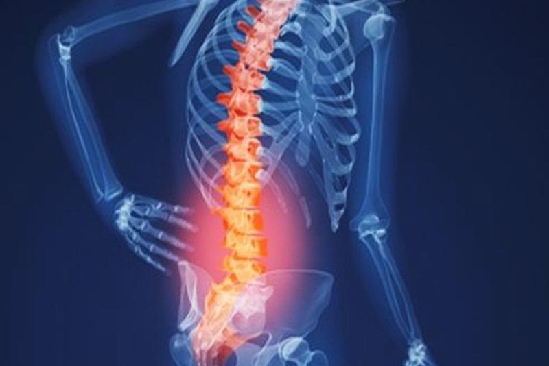Chẩn đoán đau thần kinh tọa