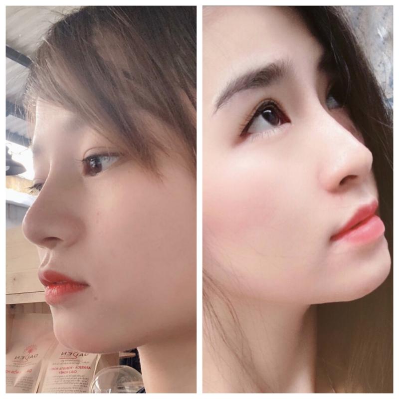 Dịch vụ nâng mũi tại Bs Lê Trần Duy