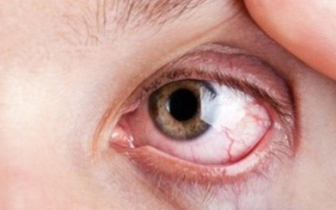Mờ mắt là biểu hiện của tăng huyết áp