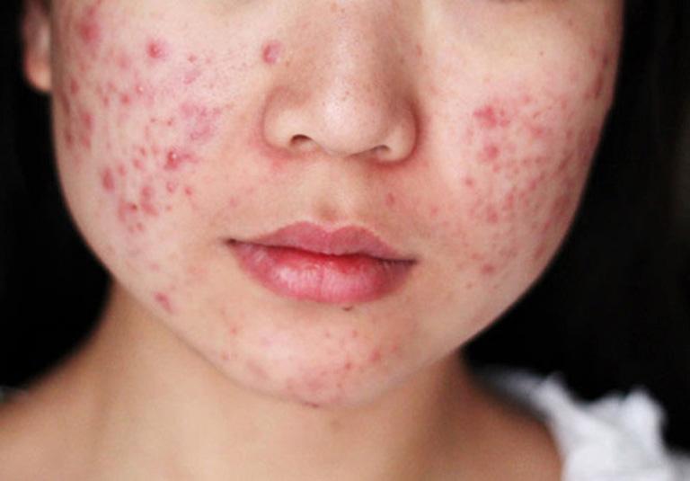 Để phòng tránh bị mụn trứng cá vào mùa hè thì chúng ta nên vệ sinh sạch sẽ khuôn mặt.