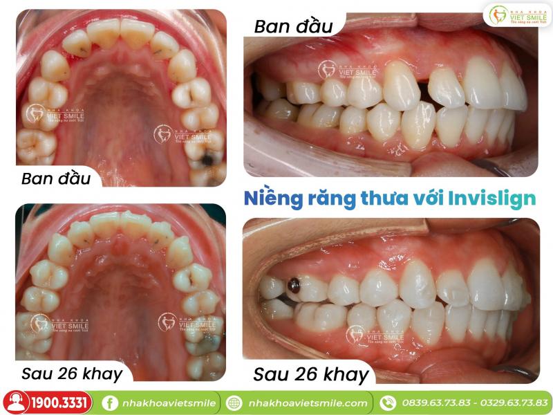 Nha Khoa VIET SMILE