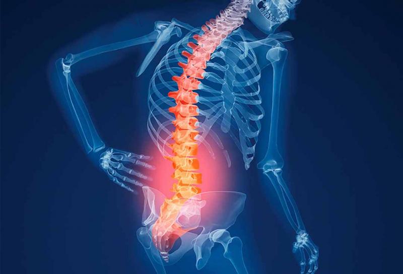 Hình ảnh minh họa về bệnh thoát vị đĩa đệm