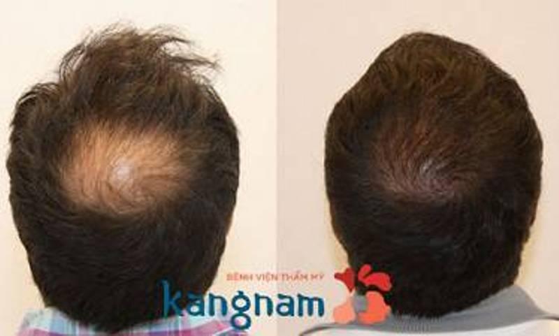 Khách hàng thực hiện cấy tóc tại Kangnam