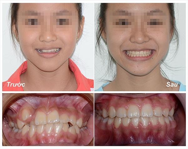 Thời gian niềng răng mắc cài kim loại