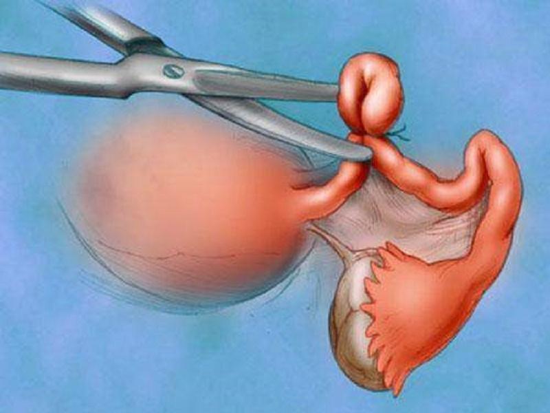 Triệt sản là cách có hiệu quả tránh thai cao