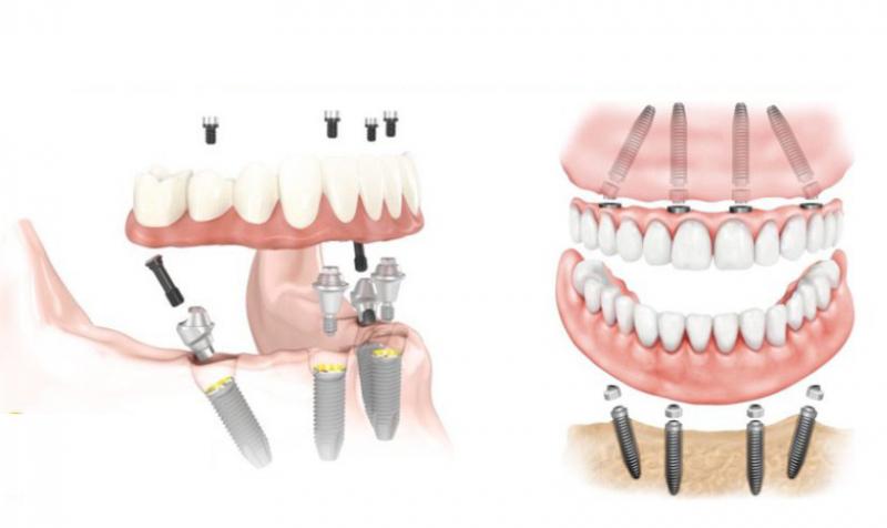 Trồng răng implant toàn hàm All-on-4