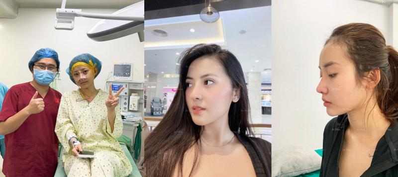 Ca nâng mũi do Bác sĩ Hồ Phi Nhạn thực hiện