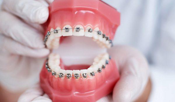 Tổng quan về niềng răng mắc cài kim loại