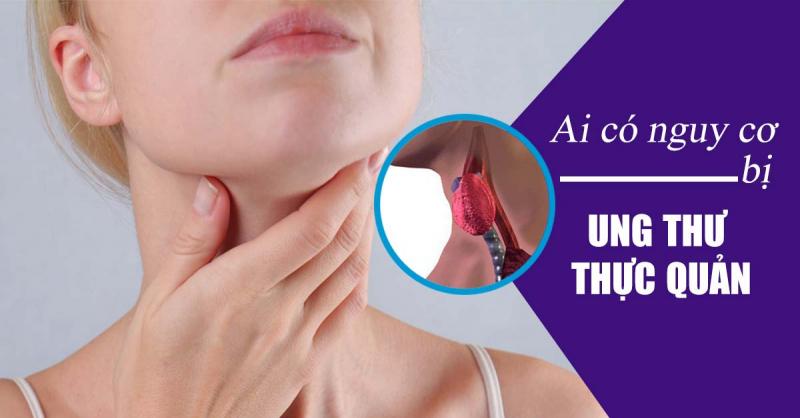 Người béo phì rất dễ mắc ung thư thực quản.