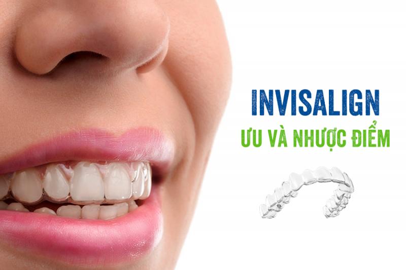 Ưu điểm của niềng răng trong suốt invisalign