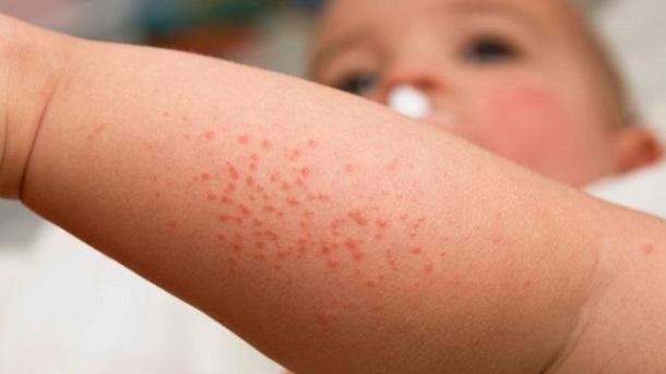 Vết phát ban gây ngứa dữ dội [