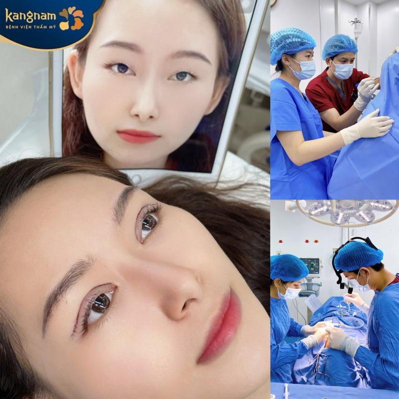 Bác sĩ bệnh viện Kangnam Hà Nội trực tiếp thực hiện dịch vụ cắt mí cho Khách hàng tại Kangnam Thanh Hóa