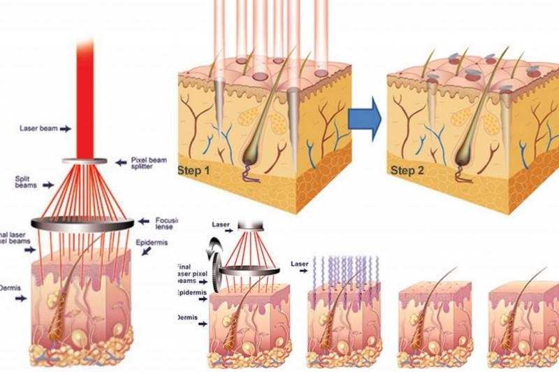 Xác định nguyên nhân gây mụn